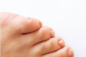 Corns Versus Calluses