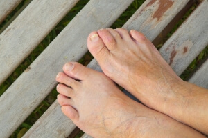 The Progressive Foot Disorder Known as Hammertoe