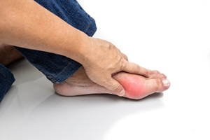 Gout and Why It Affects the Big Toe