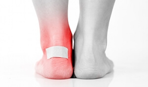 Blisters and Gait
