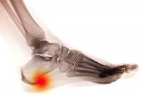 What Can Help Heel Spur Pain?