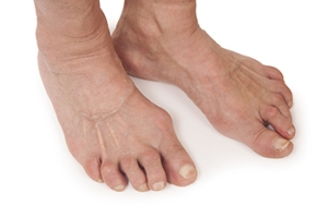 When Rheumatoid Arthritis Affects the Feet