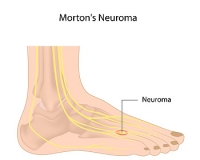 Diagnosing and Treating Morton’s Neuroma