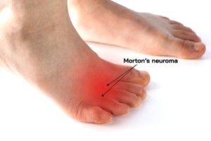 Treatment Options for Morton&rsquo;s Neuroma