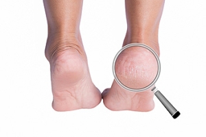 Cracked Heels and Their Vitamin Connections