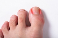 All About Ingrown Toenails