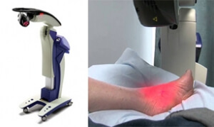 Shockwave Therapy and Plantar Fasciitis