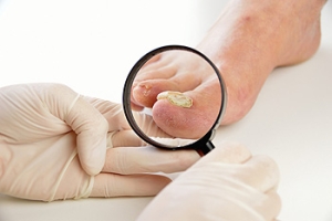 Risk Factors for Toenail Infections