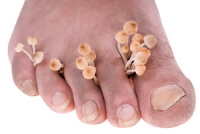 Can Toenail Fungus Be Prevented?