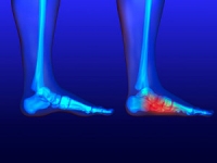 When Flat Feet Need a Surgical Solution