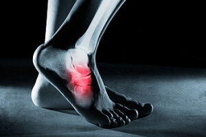 Navicular Stress Fractures