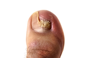 Toenail Fungus Needs Treatment