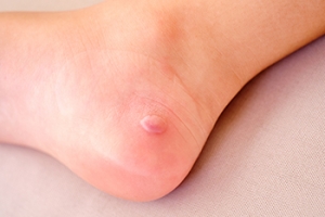 Foot Blister Causes