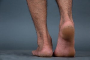 Dealing With Cracked Heels